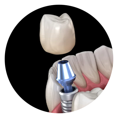 Dental Implant Model