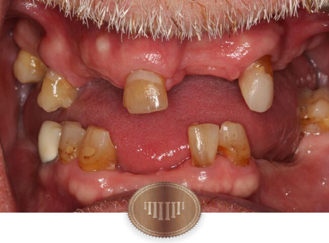 Before dental implants