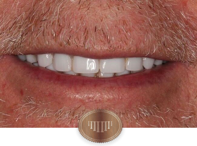 After dental implants