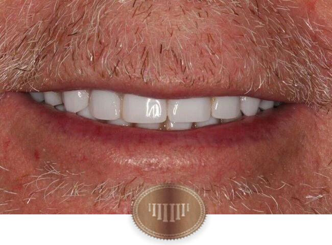 After dental implants