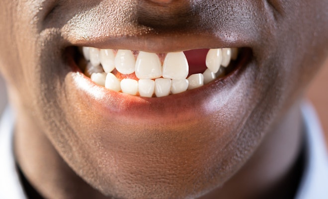 Missing tooth