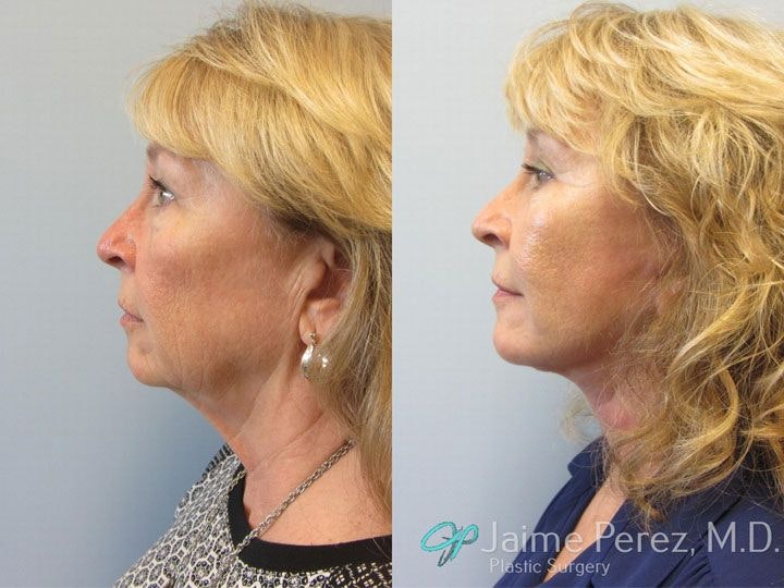 Before and After of facial plastic surgery