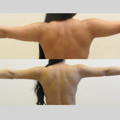 Before and after arms plastic surgery