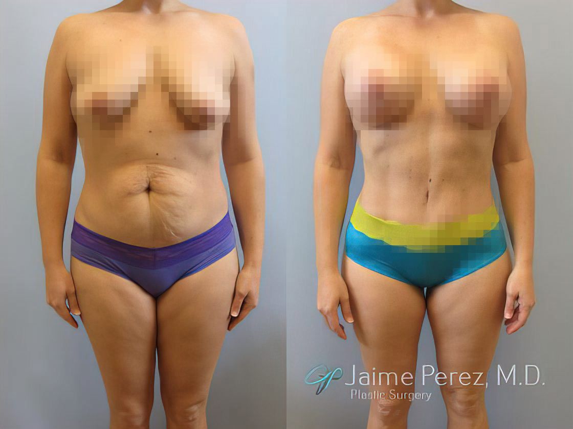 Mommy Makeover with Breast Lift and Tummy Tuck