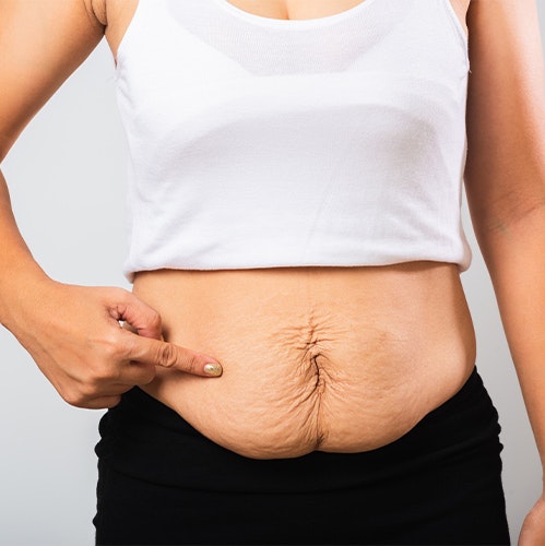 a woman with excess skin on her belly considering a tummy tuck
