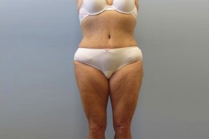 After tummy tuck