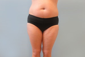 Before abdominoplasty