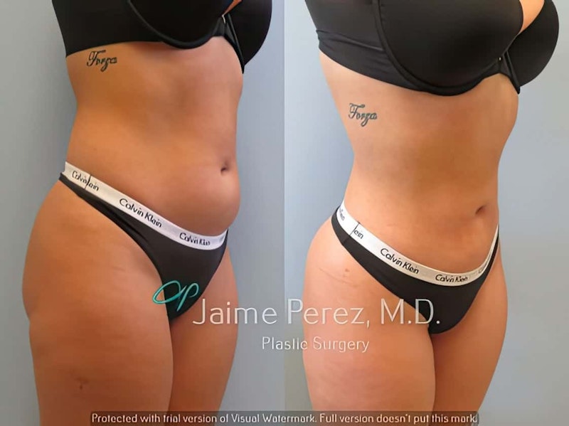 Before and after 24-year-old female with liposuction done on abdomen & around the trunk