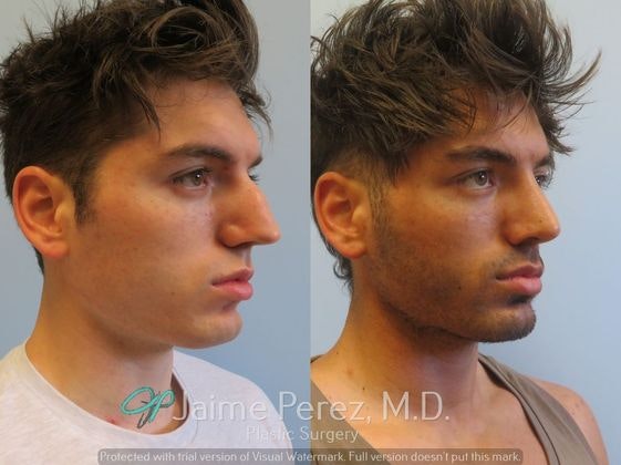 rhinoplasty before and after
