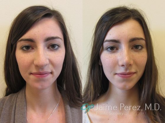 Dr. Jaime Perez's patient before and after a nose job