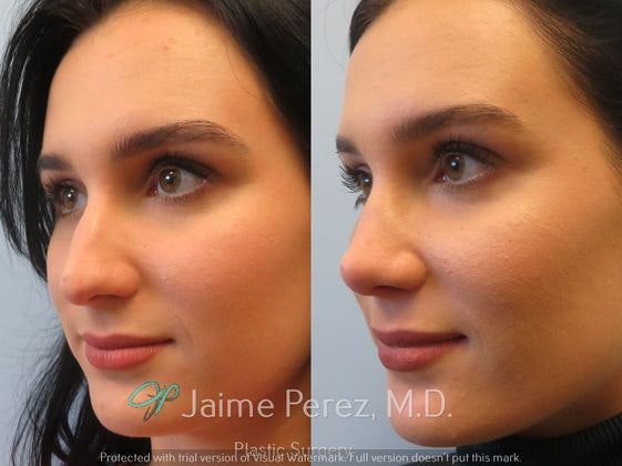 Before and after side profile of nose job