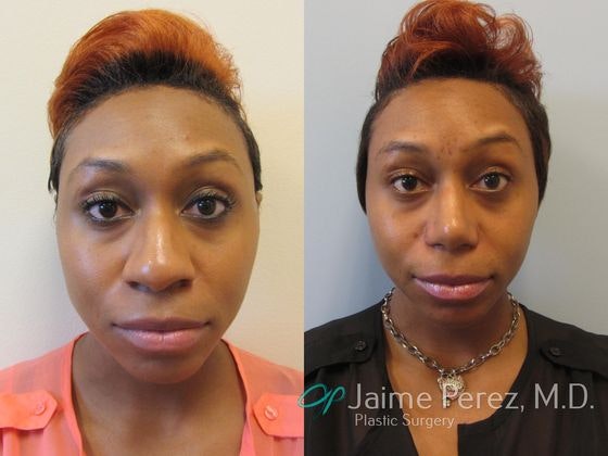 Before and after side profile of rhinoplasty