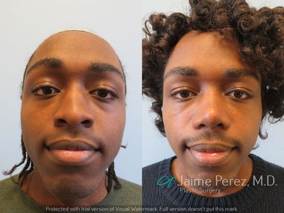 before and after nose job