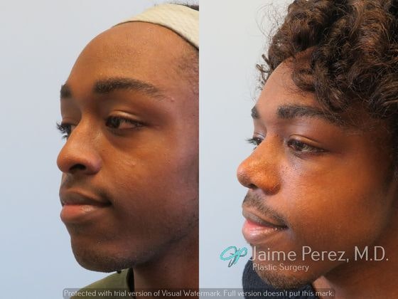 before and after nose job