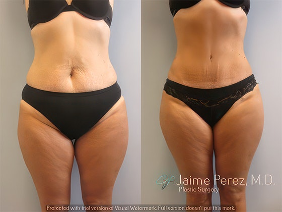 before and after tummy tuck and liposuction