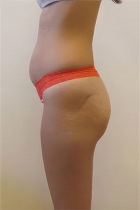 before lipo and bbl side view