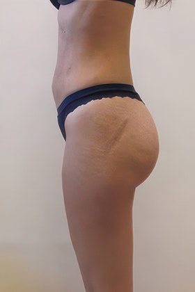 after lipo and bbl side view