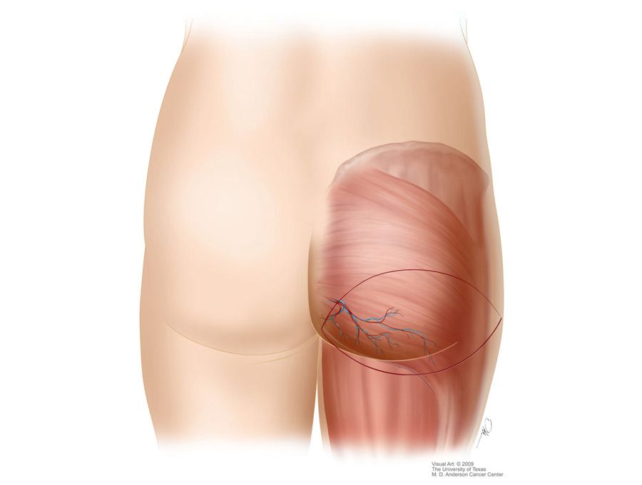 Illustration of SGAP Flap
