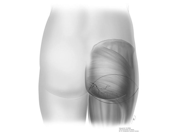 Illustration of SGAP Flap