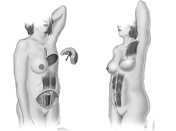 Illustration of Traditional Flap Reconstruction