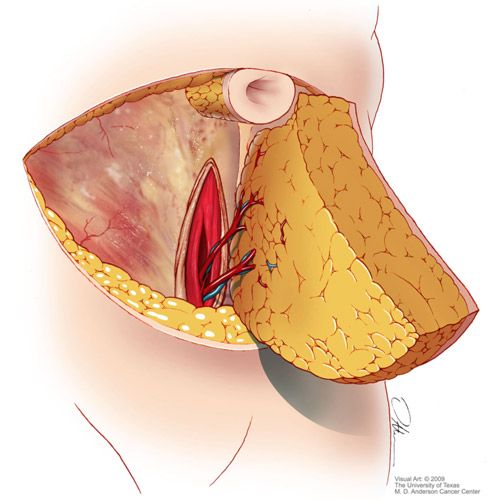 Illustration of DIEP Flap procedure in the abdomen