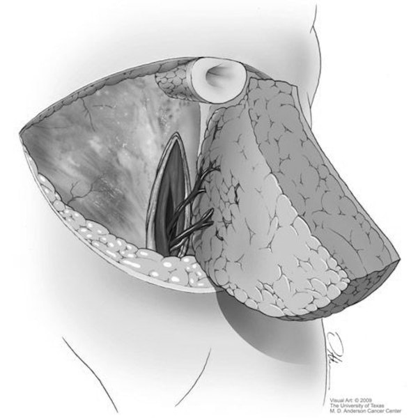 Illustration of DIEP Flap procedure in the abdomen
