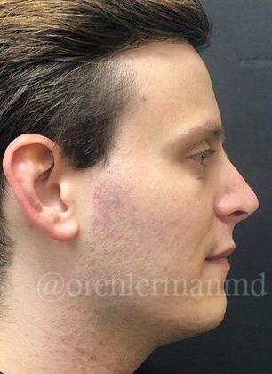 After Rhinoplasty