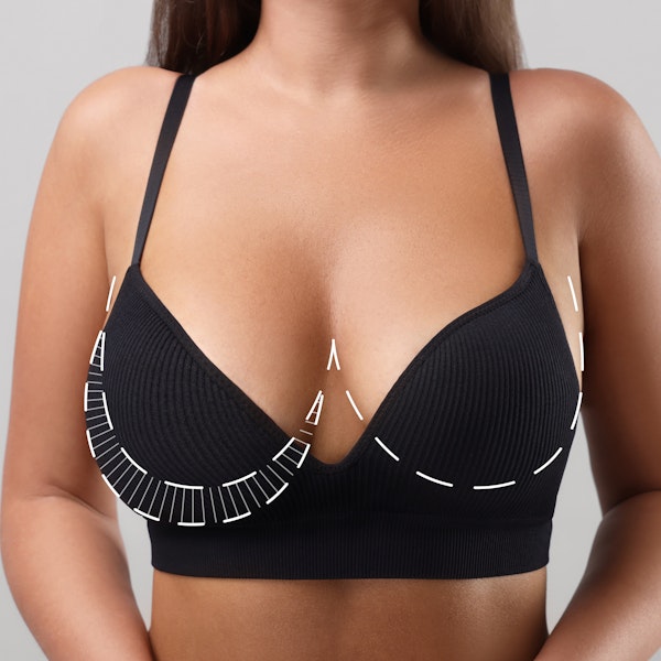 woman's midsection with lines illustrating breast lift