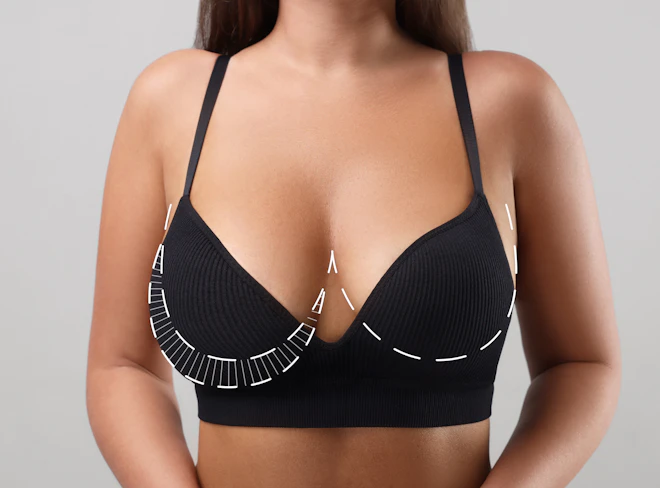 Woman wearing black bra with surgical lift markings drawn on breasts