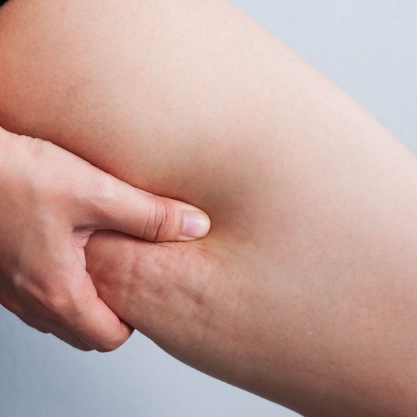 pinching excess fatty tissue