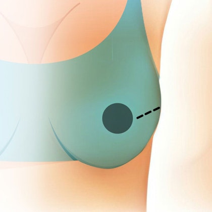 Illustration of a nipple-sparing incision