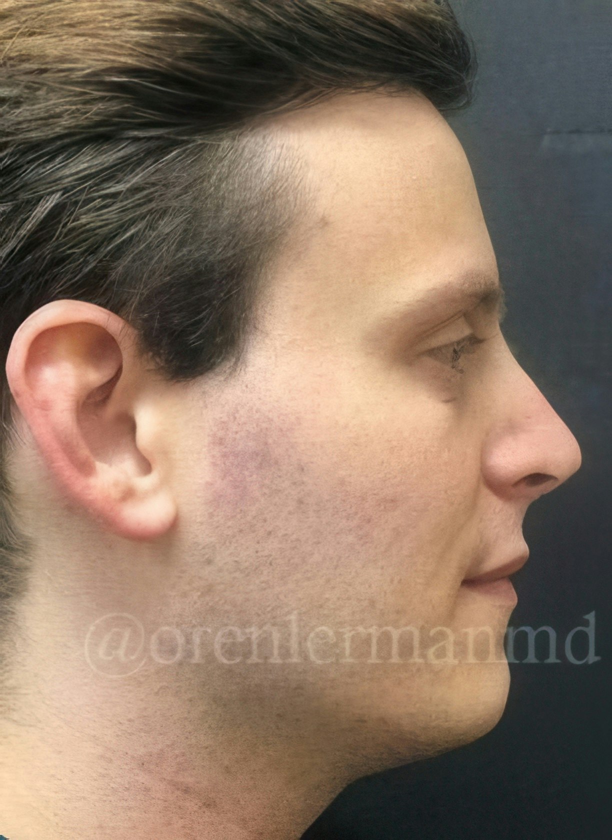 Dr. Lerman's patient after rhinoplasty