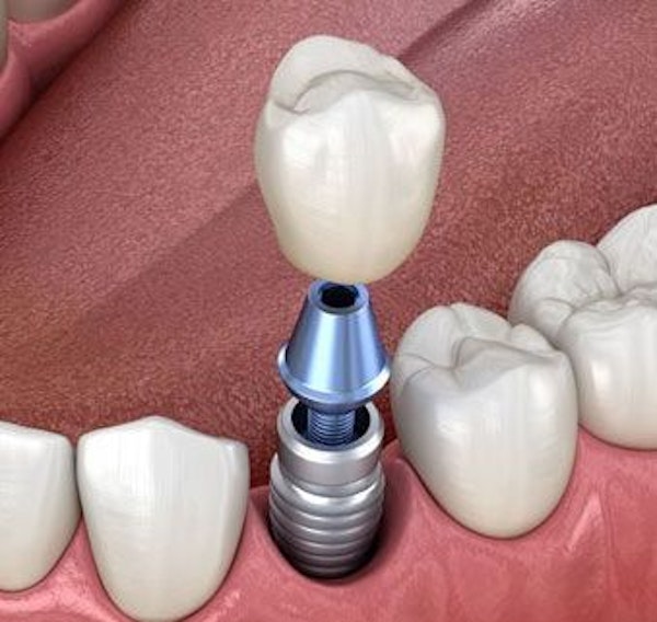Implant-supported crown