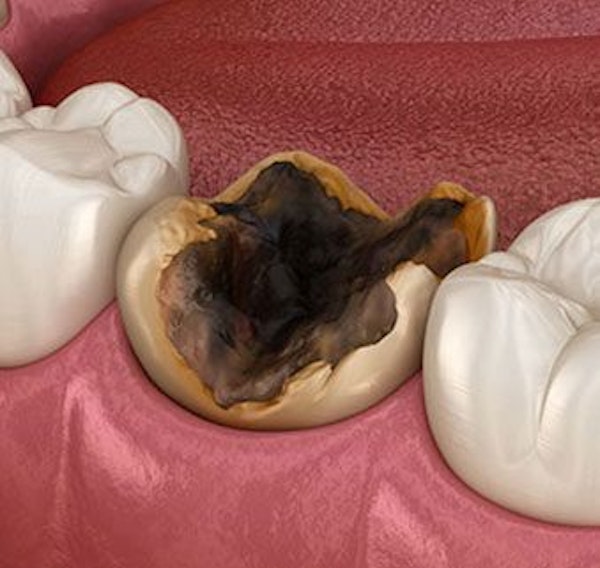 Decayed tooth