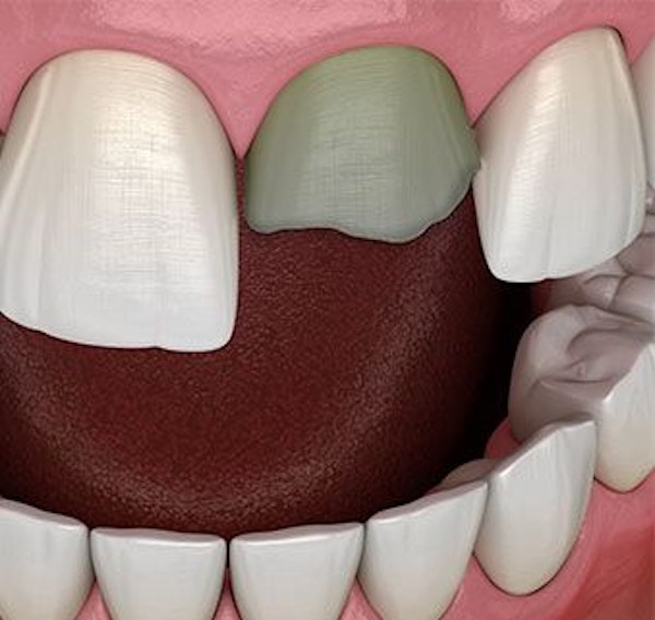 Decayed and broken tooth