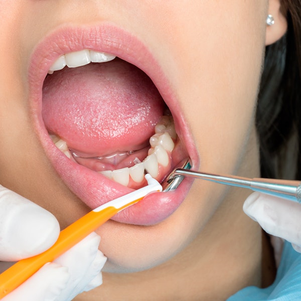 closeup of a patient's mouth during a dental cleaning