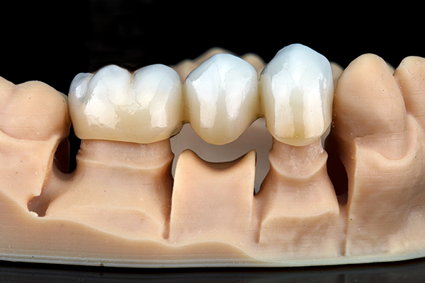 a dental bridge on a model