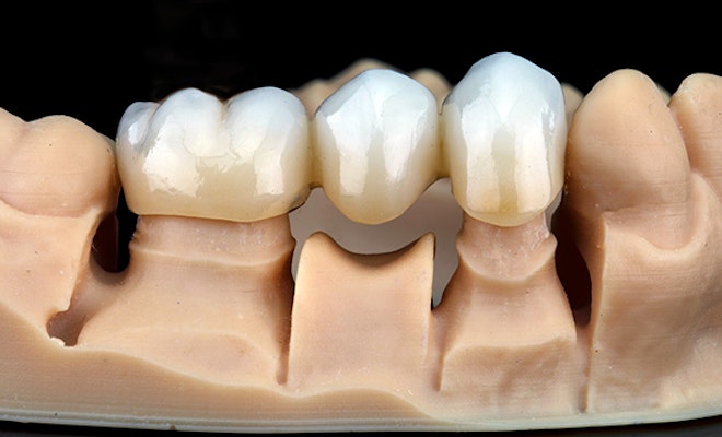 a dental bridge on a model