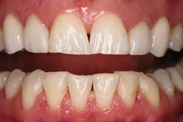 before porcelain crowns