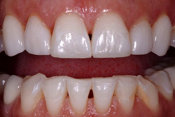 after porcelain crowns