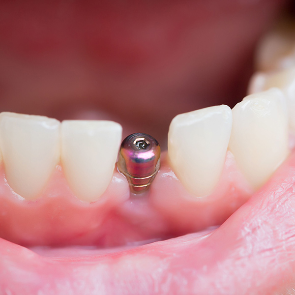 dental implant