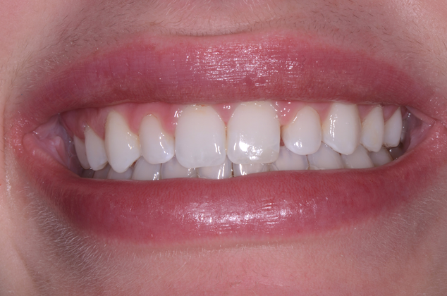before porcelain veneers