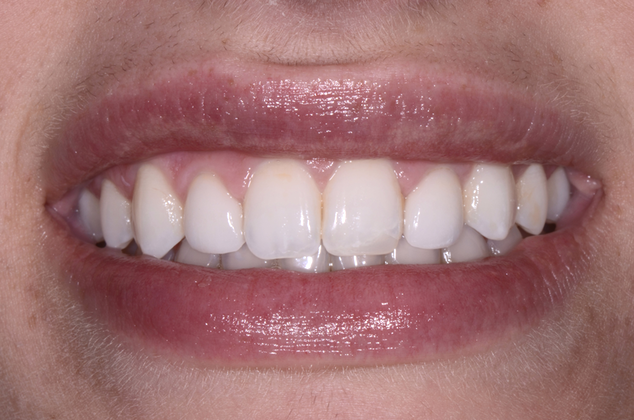 After porcelain veneers