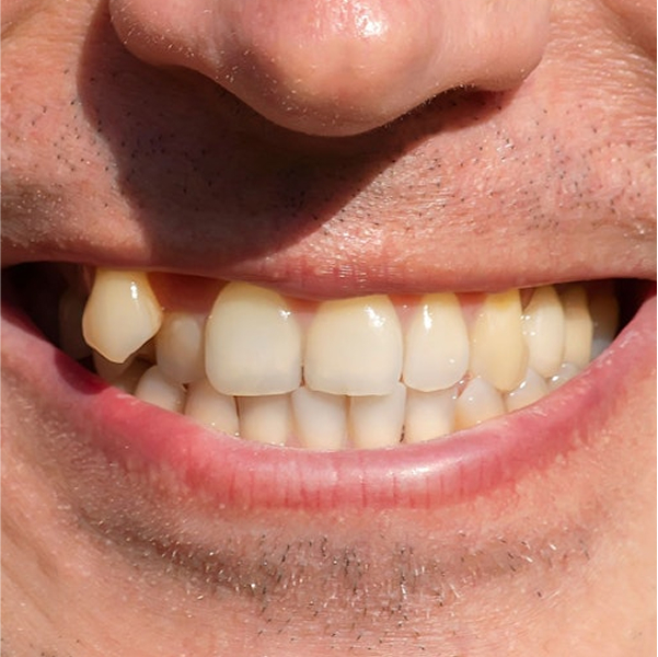 Crooked teeth