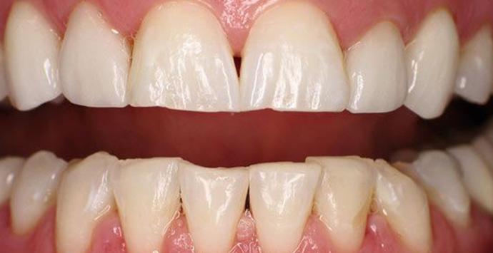 before dental crowns