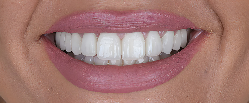 After whitening