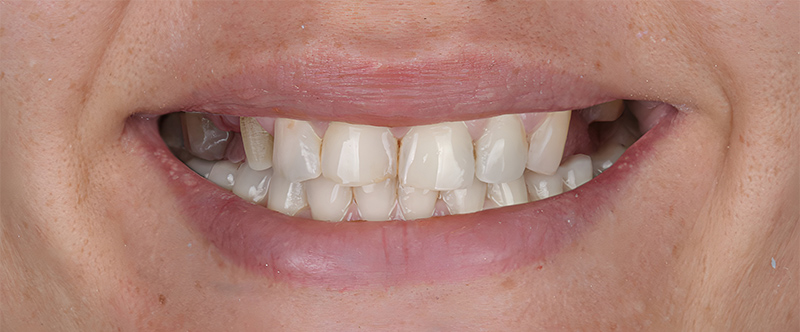 Before whitening