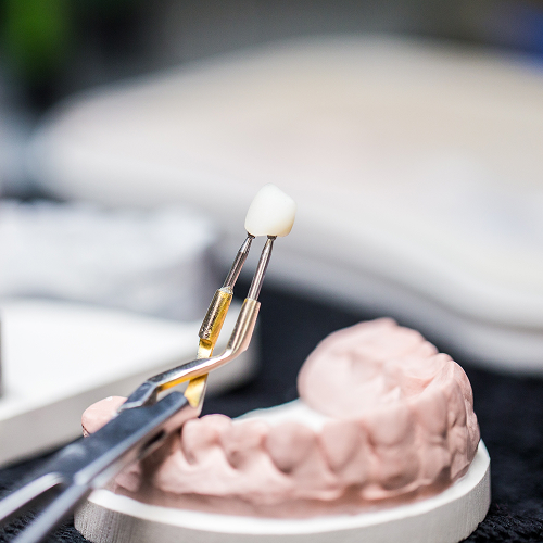 image of a model tooth and implant