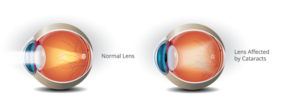 Normal lens and eye with cataract