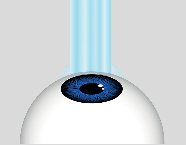 Illustration of the PRK process